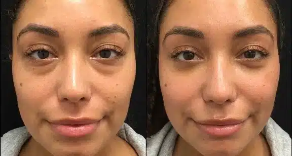 Asian Eyelid Surgery (Double Eyelid Surgery)