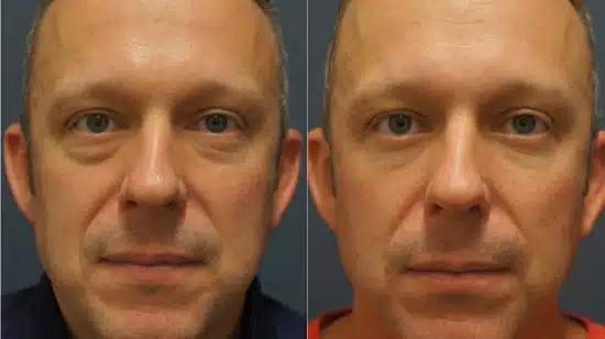 Canthoplasty / Canthopexy